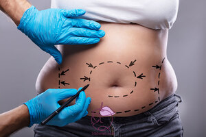 ابدومینوپلاستی - همه چیز درباره جراحی زیبایی شکم و تامی تاک