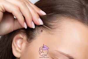 خال ها: آیا به مراقبت نیاز دارند یا همه چیز خوب است؟