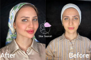 زیبایی چهره با تزریق فول فیس و تغییر زاویه فک