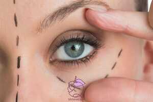 لیفت چشم با نخ: روش جدید برای جوان سازی و زیباسازی