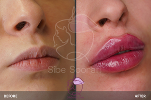 نمونه کار تزریق ژل لب