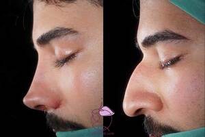 نمونه کار جراحی بینی مردانه استخوانی: عمل بینی جذاب با ظاهری متفاوت و طبیعی