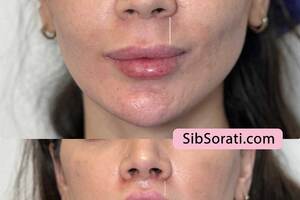 نمونه کار کم کردن فاصله بین بینی و لب‌ها با جراحی سانترال لب + تصاویر قبل و بعد از درمان