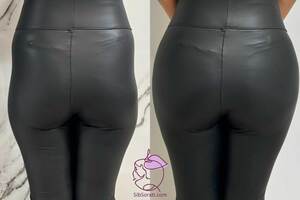 نمونه کار فیلر باسن به همراه عکس های قبل و بعد