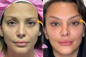 نمونه کار لیفت شقیقه + تغییرات قبل و بعد از جراحی زیبایی