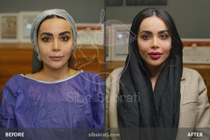 نمونه کار مادلینگ فول فیس فیلر و ژل