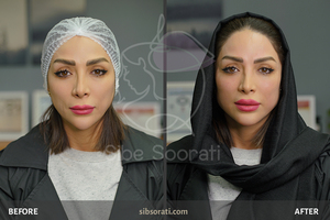 نمونه کار مدلینگ ژل و بوتاکس - تزریق بوتاکس و ژل برای زاویه فک و زیباسازی صورت