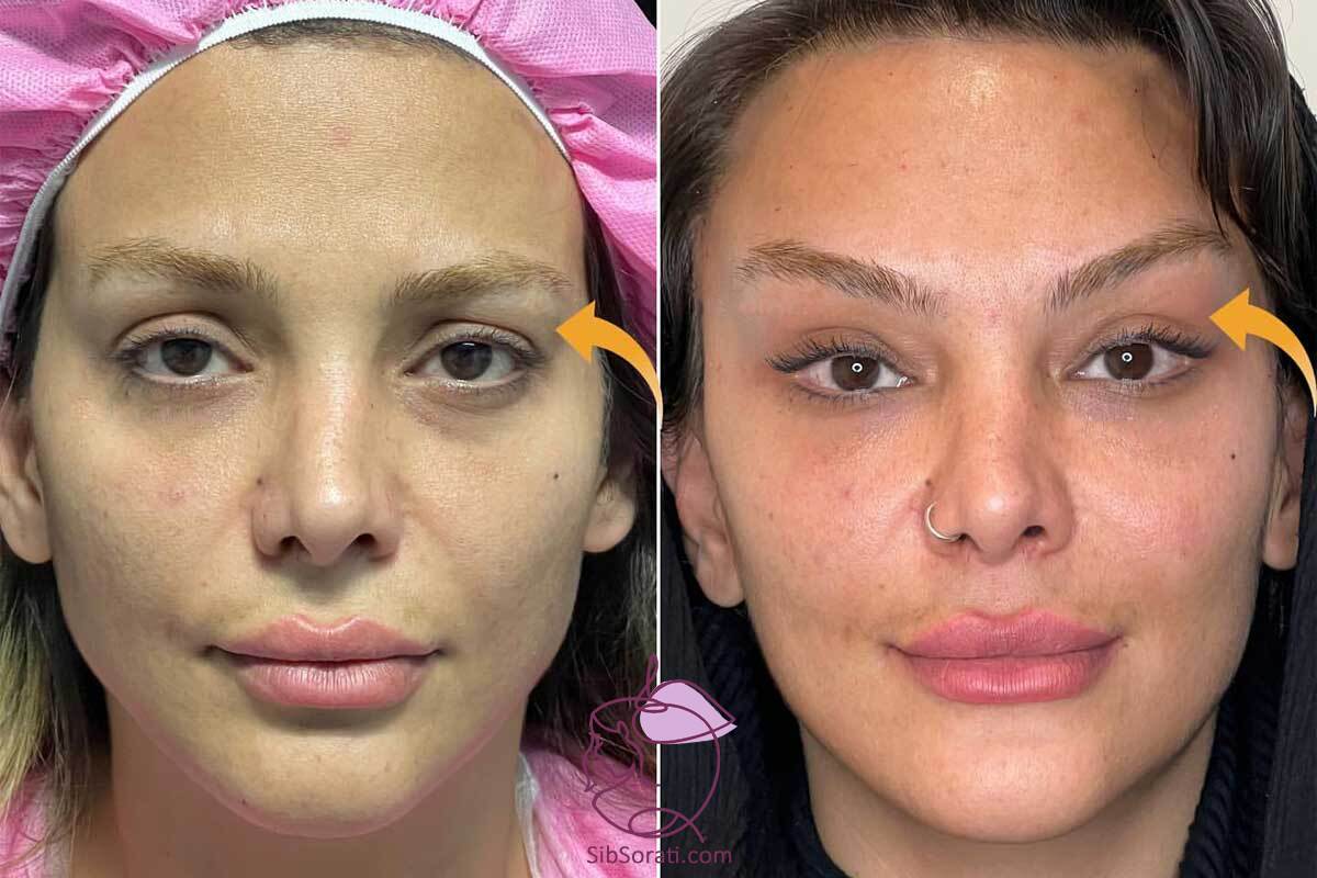 نمونه کار لیفت شقیقه + تغییرات قبل و بعد از جراحی زیبایی نمونه کار لیفت شقیقه + تغییرات قبل و بعد از جراحی زیبایی
